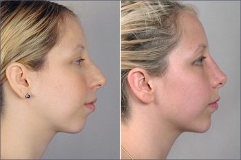 Rhinoplasty & Chin Implant Patient 2