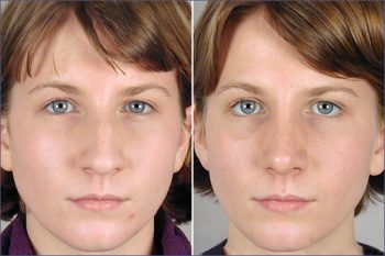 Rhinoplasty Patient 3