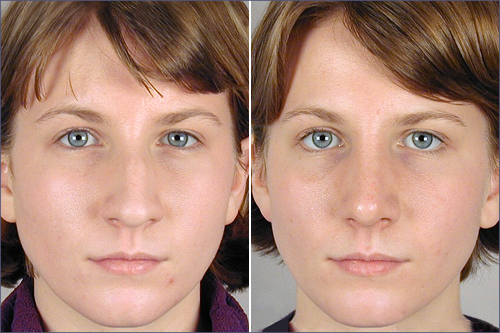 Rhinoplasty Patient 3