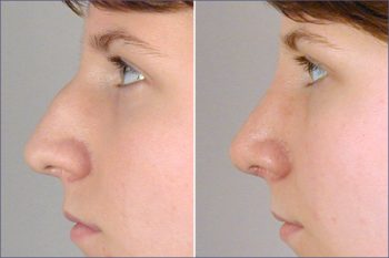 Rhinoplasty Patient 3