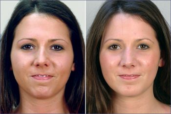 Rhinoplasty & Chin Implant Patient 4