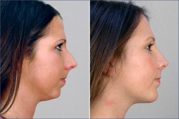 Rhinoplasty & Chin Implant Patient 4