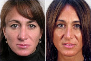 Rhinoplasty Patient 5