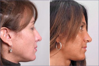 Rhinoplasty Patient 5