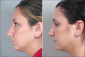 Rhinoplasty Patient 6
