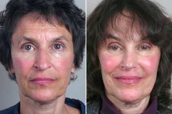 Rhinoplasty Patient 7