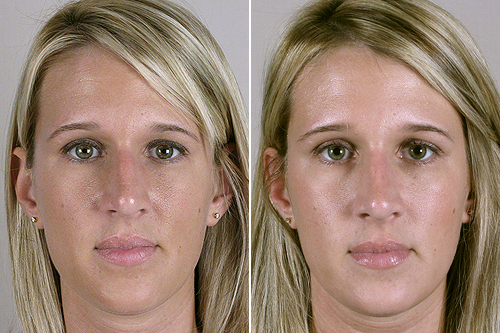 Rhinoplasty Patient 10