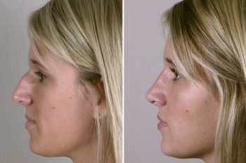 Rhinoplasty Patient 10