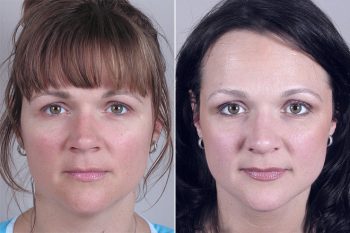 Rhinoplasty Patient 11