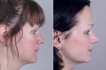 Rhinoplasty Patient 11