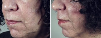 Skin Cancer Treatment Patient 7