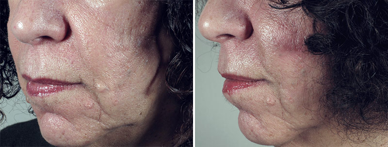 Skin Cancer Treatment Patient 7