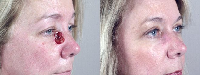 Skin Cancer Treatment Patient 8