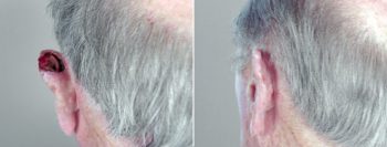 Skin Cancer Treatment Patient 1