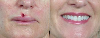 Skin Cancer Treatment Patient 2