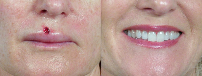 Skin Cancer Treatment Patient 2