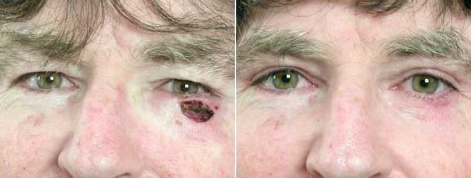 Skin Cancer Treatment Patient 3