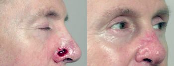 Skin Cancer Treatment Patient 4