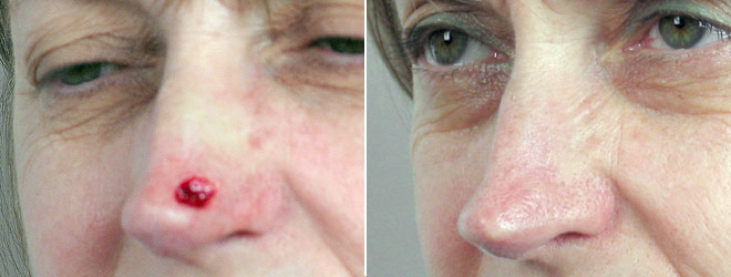 Skin Cancer Treatment Patient 5