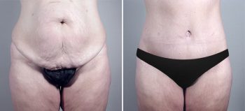 Parker Tummy Tuck Patient 16