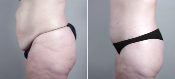 Parker Tummy Tuck Patient 16