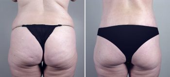 Parker Tummy Tuck Patient 16