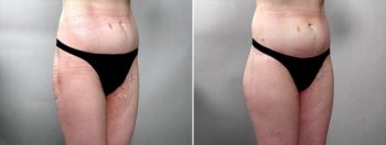 Thigh & Buttocks Lifting Surgery Patient 1