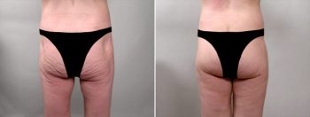 Thigh & Buttocks Lifting Surgery Patient 1