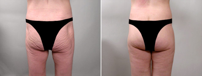 Thigh & Buttocks Lifting Surgery Patient 1