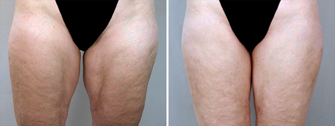 Inner Thigh & Body Lifting Surgery Patient 2