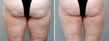 Inner Thigh & Body Lifting Surgery Patient 2