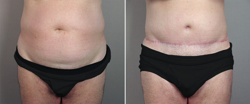 Male Abdominoplasty Patient 2