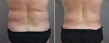 Male Abdominoplasty Patient 2