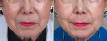 Wrinkle Reduction Patient 1 – Dermabrasion