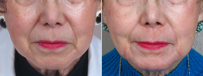 Wrinkle Reduction Patient 1 – Dermabrasion