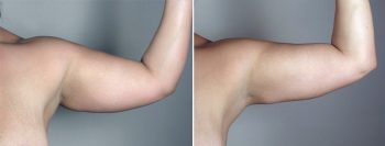 Liposuction Patient 29