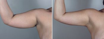 Liposuction Patient 29