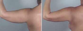 Liposuction Patient 29