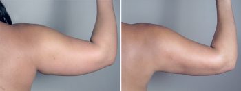 Liposuction Patient 29
