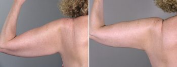 Upper Arm Rejuvenation Patient 5 – Arm Lift