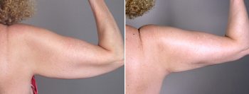 Upper Arm Rejuvenation Patient 5 – Arm Lift