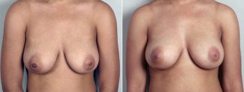 Inverted Nipple Correction Patient 1