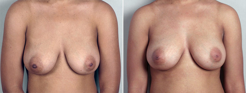 Inverted Nipple Correction Patient 1