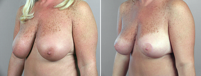breast_reduction_16b1.jpg