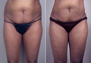 Liposuction Patient 23