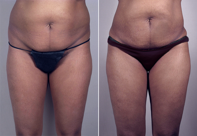 Liposuction Patient 23