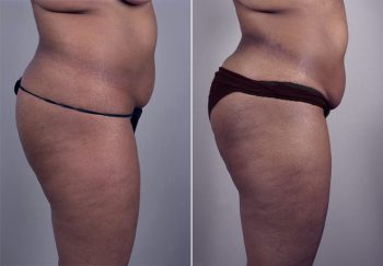 Liposuction Patient 23