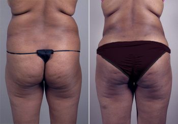Liposuction Patient 23
