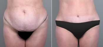 Classic Tummy Tuck Patient 13