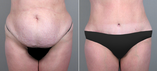 Classic Tummy Tuck Patient 13